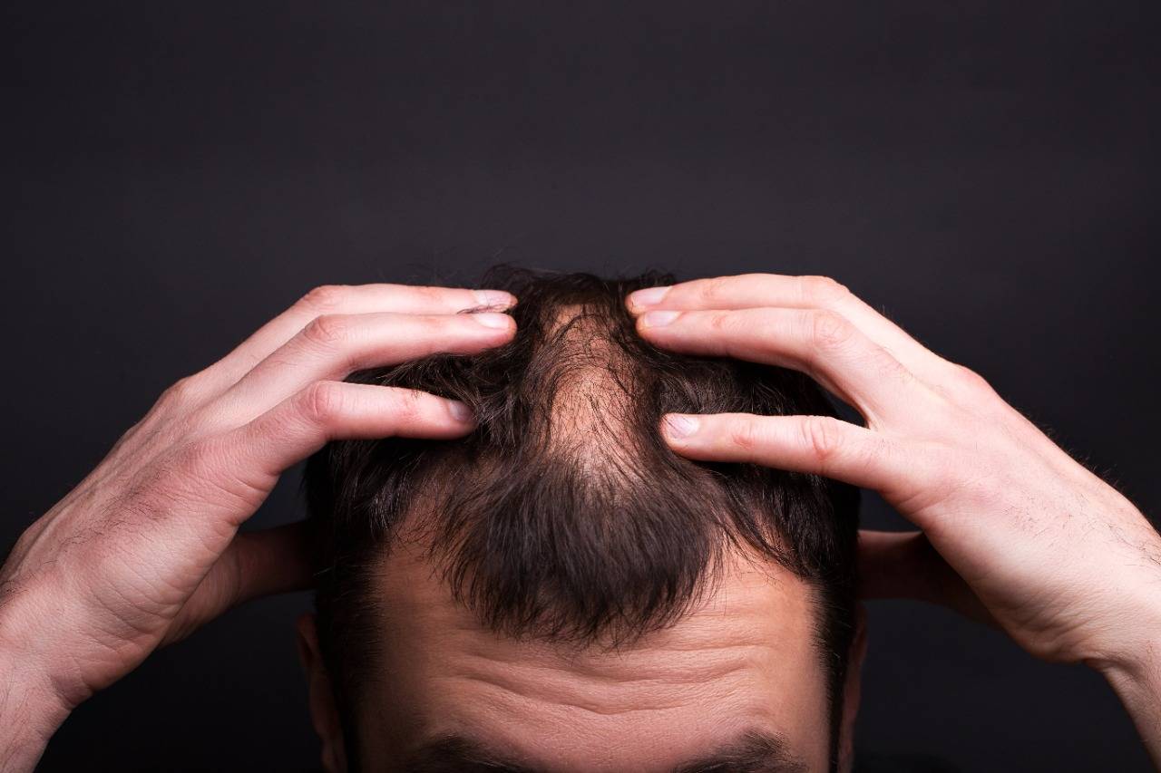 Hair Transplant In Kolkata