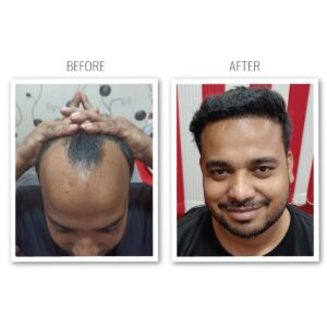 Read more about the article How Long Do Hair Transplants Last? Exploring the Longevity of Hair Restoration