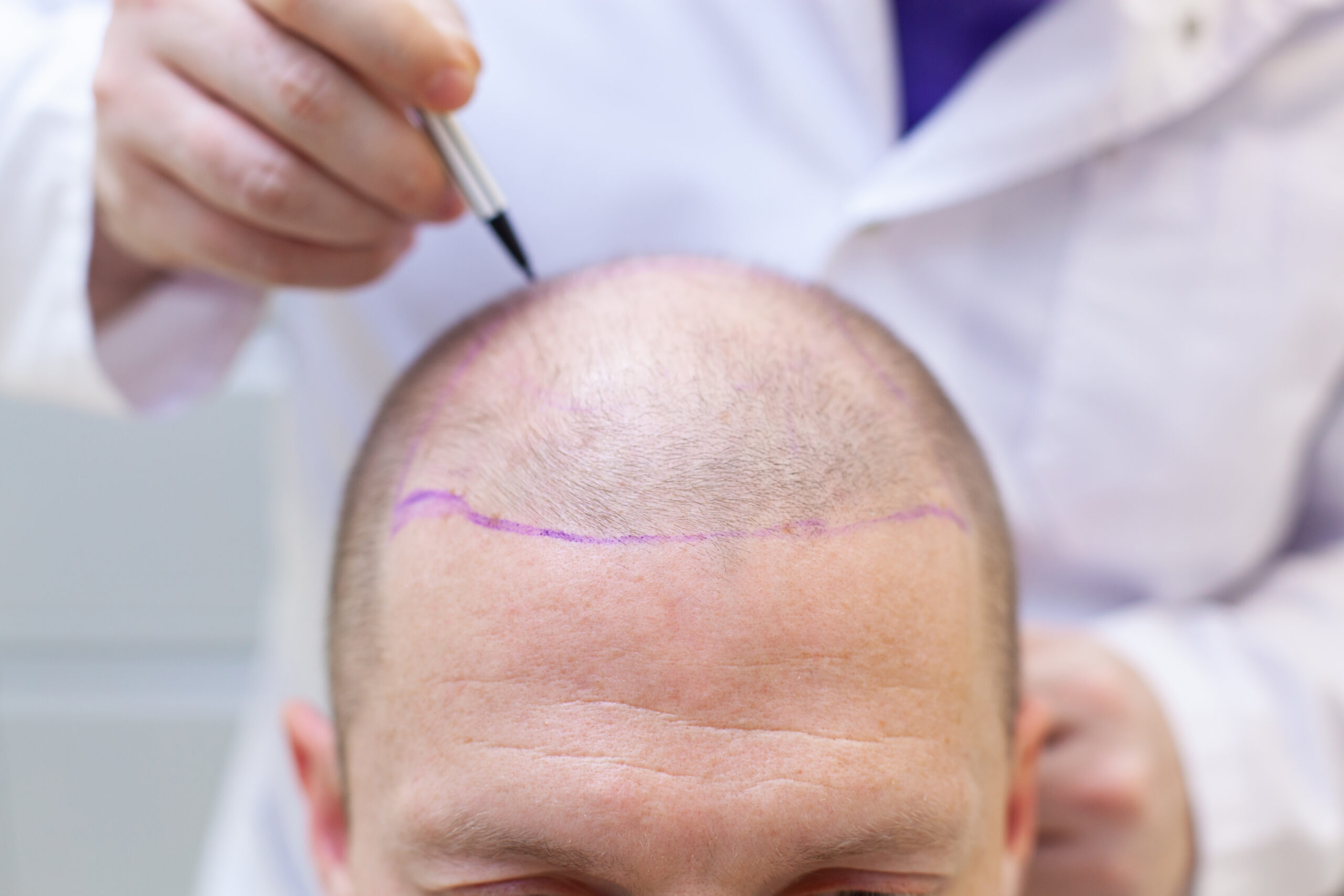 Read more about the article The Modern Approach to Hair Transplants for Natural Results