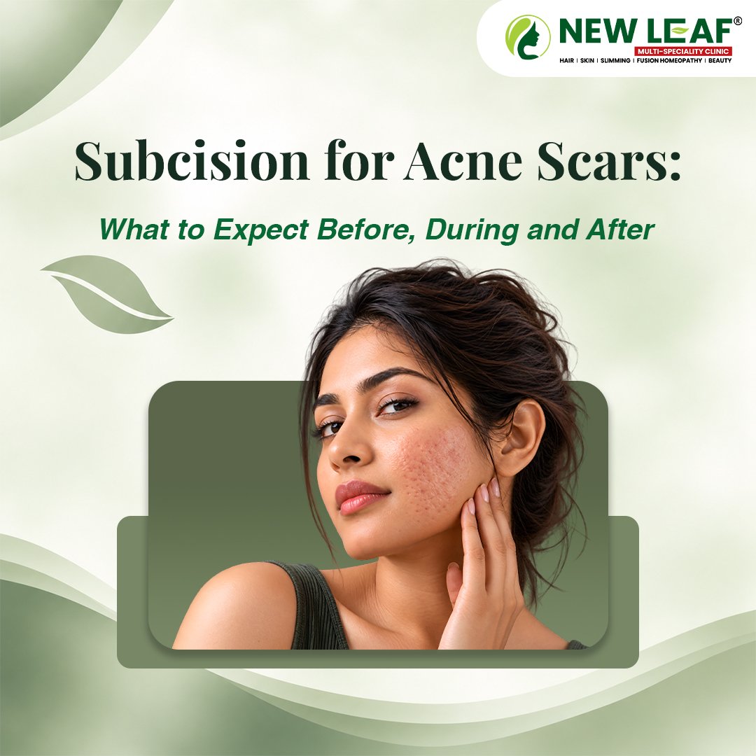 You are currently viewing Subcision for Acne Scars: What to Expect Before, During and After